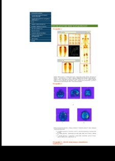 Ciekawe przykłady badań scyntygraficznych - Katedra i Zakład Medycyny Nuklearnej Uniwersytetu Medycznego w Lublinie